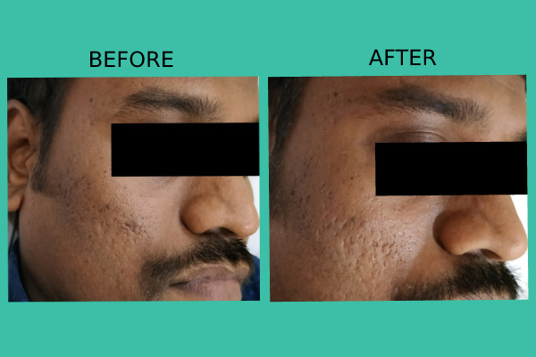 Before After treatment results of patients by Dr. Nandini Gupta, the best dermatologist in Kharghar, Navi Mumbai.