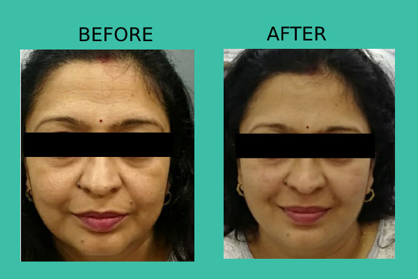 Before After treatment results of patients by Dr. Nandini Gupta, the best dermatologist in Kharghar, Navi Mumbai.