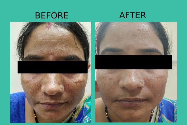 Before After treatment results of patients by Dr. Nandini Gupta, the best dermatologist in Kharghar, Navi Mumbai.