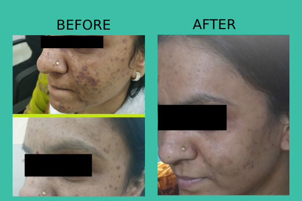Before After treatment results of patients by Dr. Nandini Gupta, the best dermatologist in Kharghar, Navi Mumbai.
